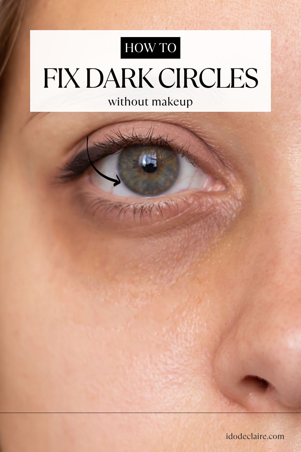 How To Fix Dark Circles Under the Eyes Without Makeup